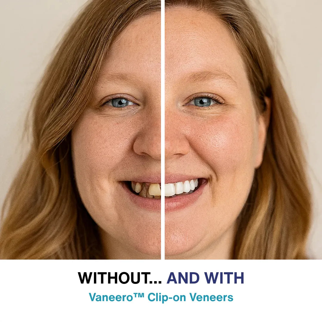 Vaneero™ Clip-on Veneers