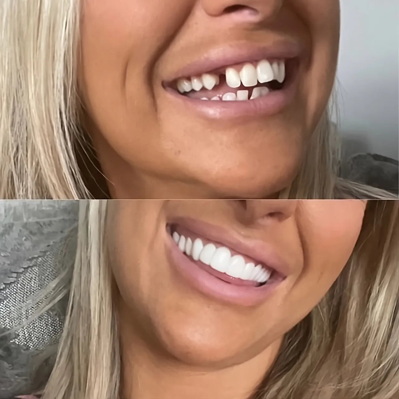Veenora clip-on veneers for a natural-looking smile, perfect dental solution and cosmetic teeth enhancement.